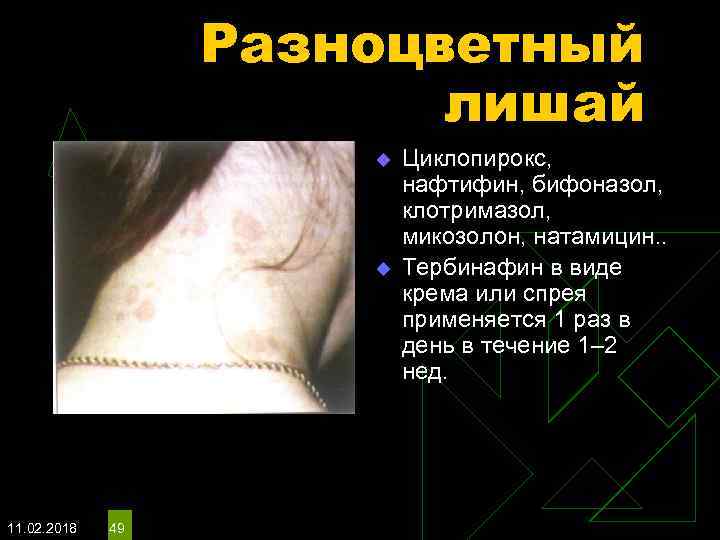 Разноцветный лишай u u 11. 02. 2018 49 Циклопирокс, нафтифин, бифоназол, клотримазол, микозолон, натамицин.