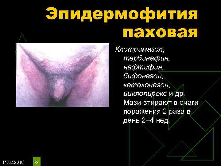 Эпидермофития паховая Клотримазол, тербинафин, нафтифин, бифоназол, кетоконазол, циклопирокс и др. Мази втирают в очаги