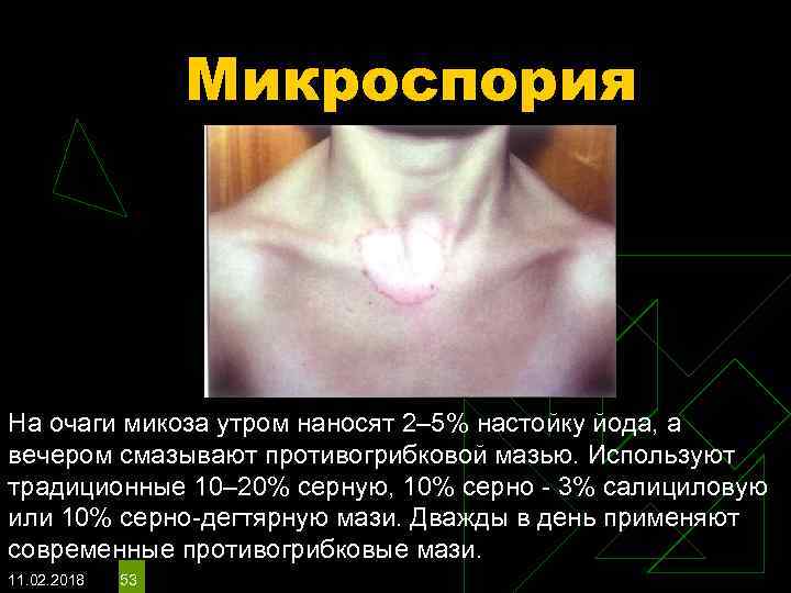 Микроспория На очаги микоза утром наносят 2– 5% настойку йода, а вечером смазывают противогрибковой
