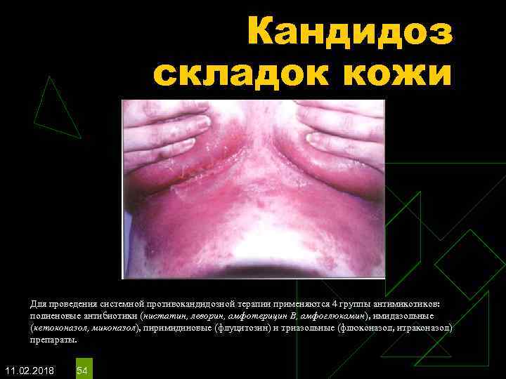 Кандидоз складок кожи Для проведения системной противокандидозной терапии применяются 4 группы антимикотиков: полиеновые антибиотики