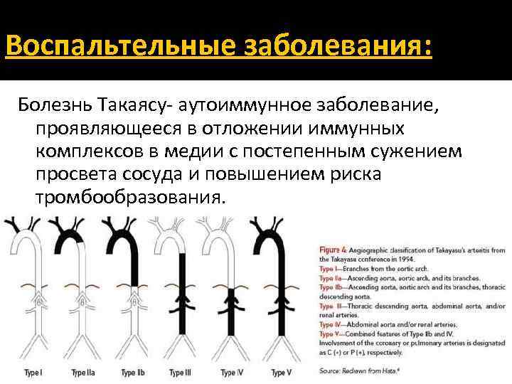 Воспальтельные заболевания: Болезнь Такаясу- аутоиммунное заболевание, проявляющееся в отложении иммунных комплексов в медии с