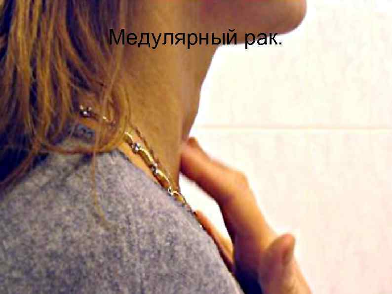 Медулярный рак. 