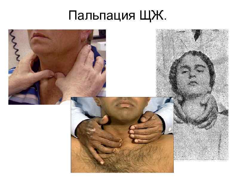 Пальпация ЩЖ. 