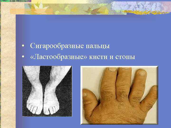  • Сигарообразные пальцы • «Ластообразные» кисти и стопы 