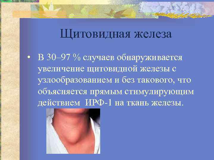 Щитовидная железа • В 30– 97 % случаев обнаруживается увеличение щитовидной железы с узлообразованием