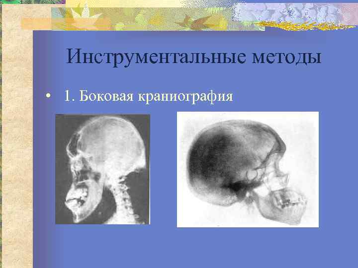Инструментальные методы • 1. Боковая краниография 
