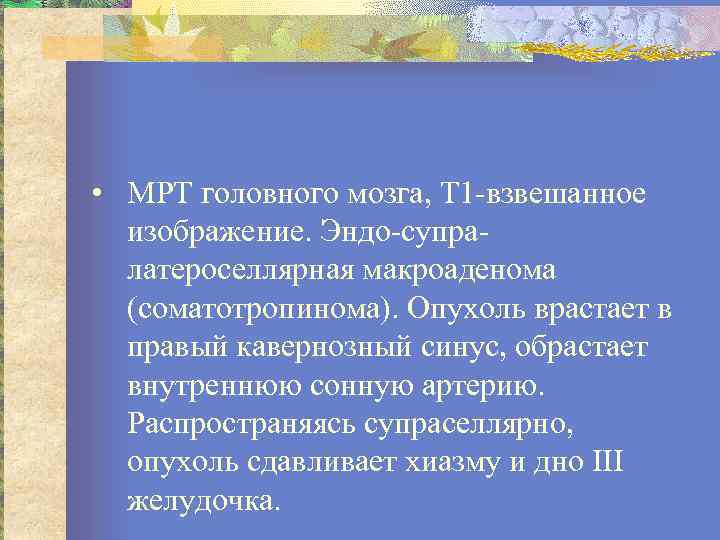  • МРТ головного мозга, Т 1 взвешанное изображение. Эндо супра латероселлярная макроаденома (соматотропинома).