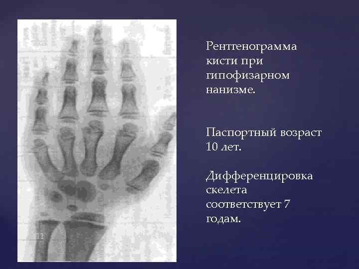 Рентгенограмма кисти при гипофизарном нанизме. Паспортный возраст 10 лет. Дифференцировка скелета соответствует 7 годам.