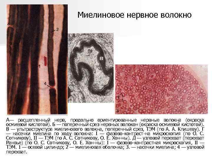 Миелиновое нервное волокно А— расщепленный нерв, продольно ориентированные нервные волокна (окраска осмиевой кислотой). Б