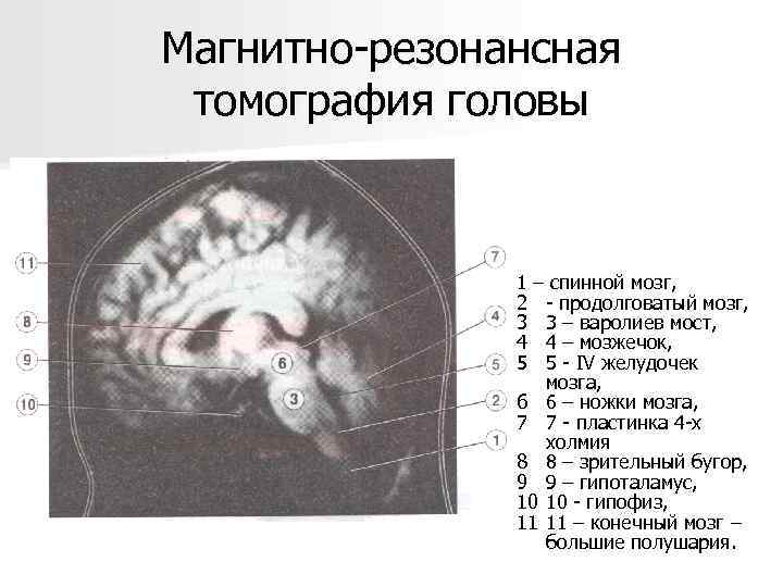 Магнитно-резонансная томография головы 1 – спинной мозг, 2 - продолговатый мозг, 3 3 –