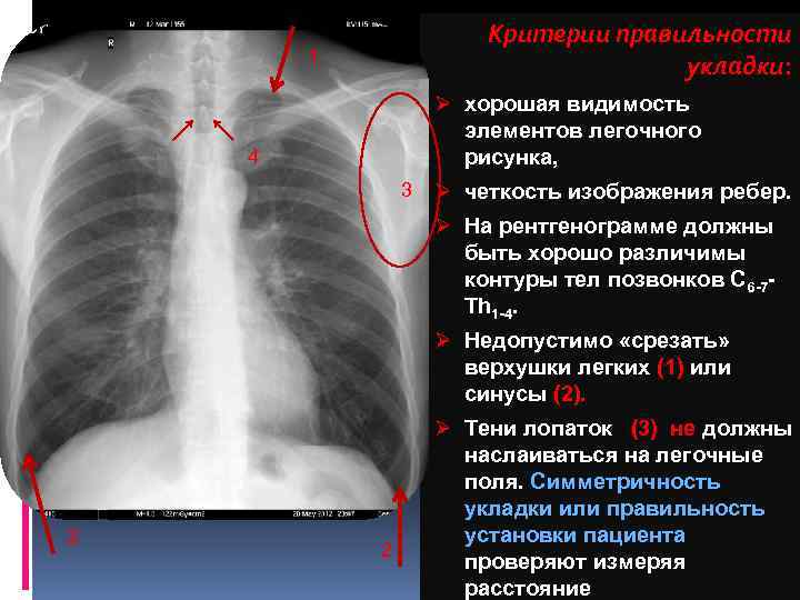 Легочный рисунок деформирован что это значит. Подсчет ребер на рентгенограмме. Как посчитать ребра на рентгенограмме. Как считать ребра на рентгенограмме.