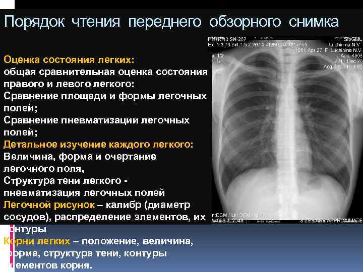 Пневматизация. Пневматизация легочной ткани сохранена что это. Снижена пневматизация легочной ткани. Пневматизация легких. Пневматизация легочных полей.