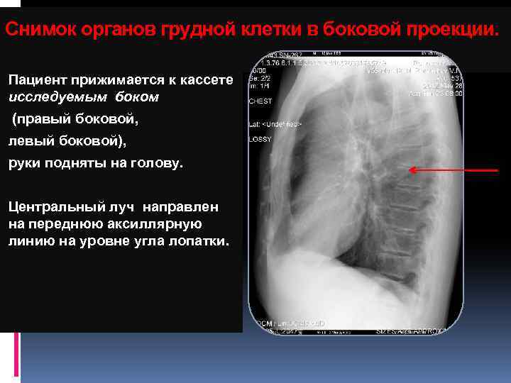 Рентгенограмма в боковой проекции. Рентген грудной клетки боковая проекция. Рентген ОГК В правой боковой проекции.