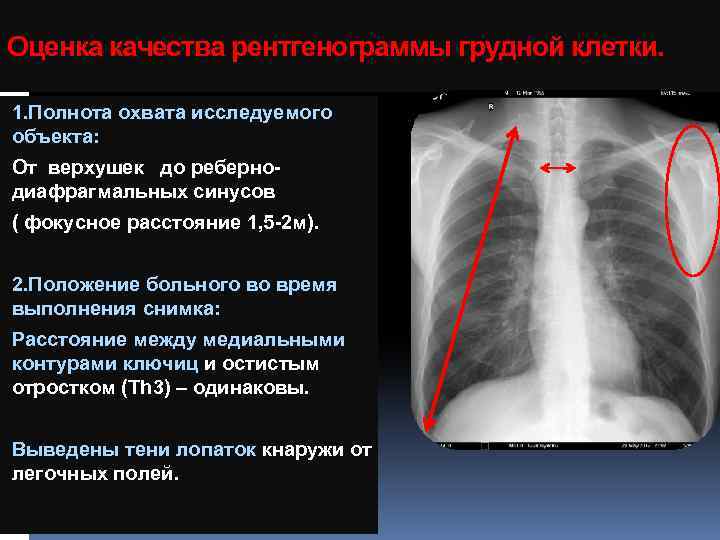 План описания рентгенограммы легких