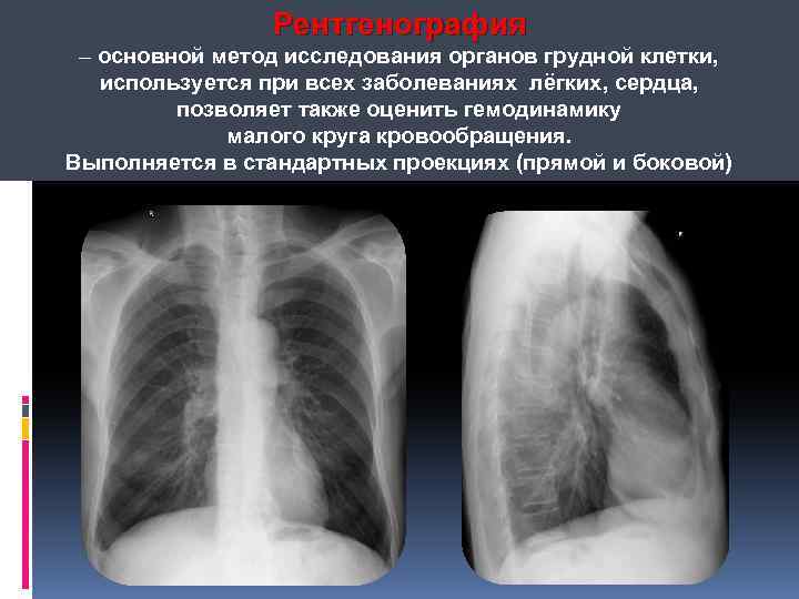 Нормальная лучевая картина органов грудной клетки