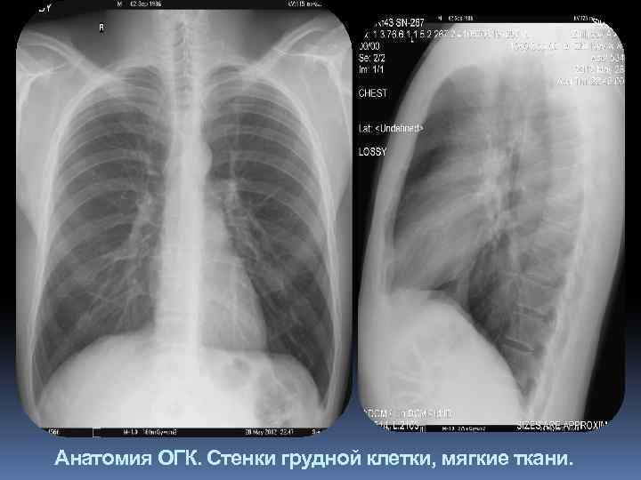 Анатомия ОГК. Стенки грудной клетки, мягкие ткани. 