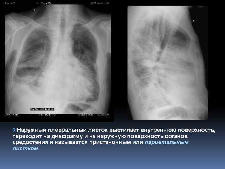 Плевра ØНаружный плевральный листок выстилает внутреннюю поверхность, переходит на диафрагму и на наружную поверхность