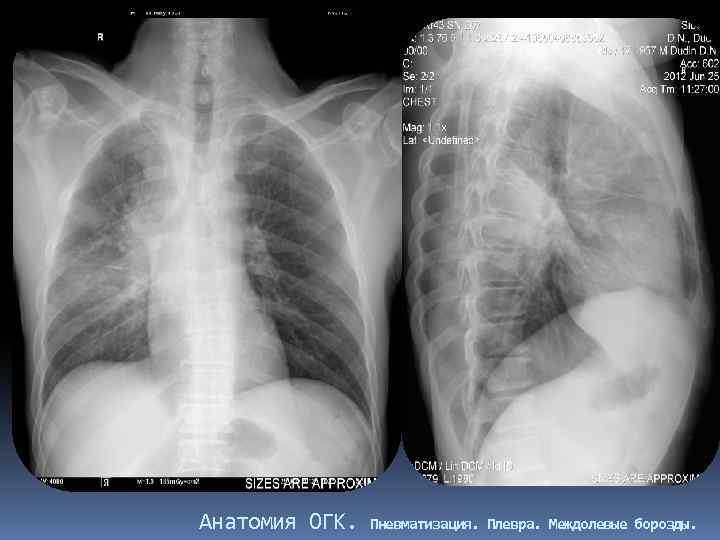Анатомия ОГК. Пневматизация. Плевра. Междолевые борозды. 