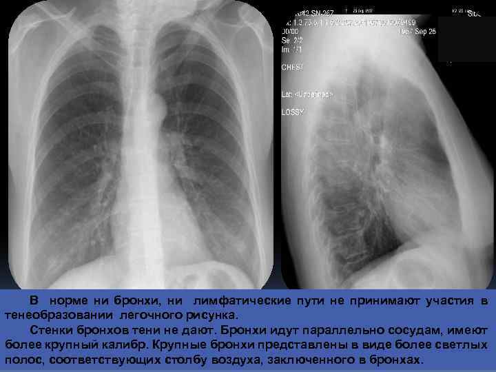 В норме ни бронхи, ни лимфатические пути не принимают участия в тенеобразовании легочного рисунка.