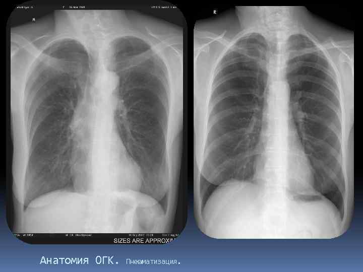 Анатомия ОГК. Пневматизация. 