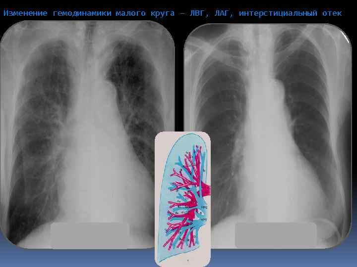 Изменение гемодинамики малого круга – ЛВГ, ЛАГ, интерстициальный отек 