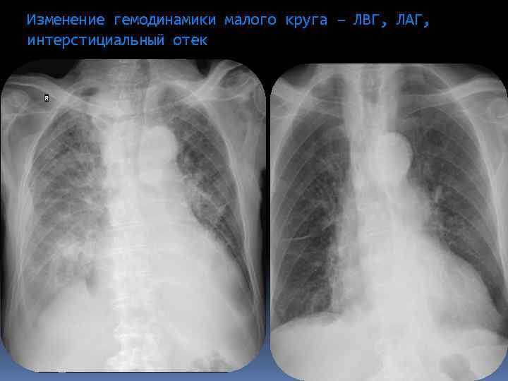Изменение гемодинамики малого круга – ЛВГ, ЛАГ, интерстициальный отек 