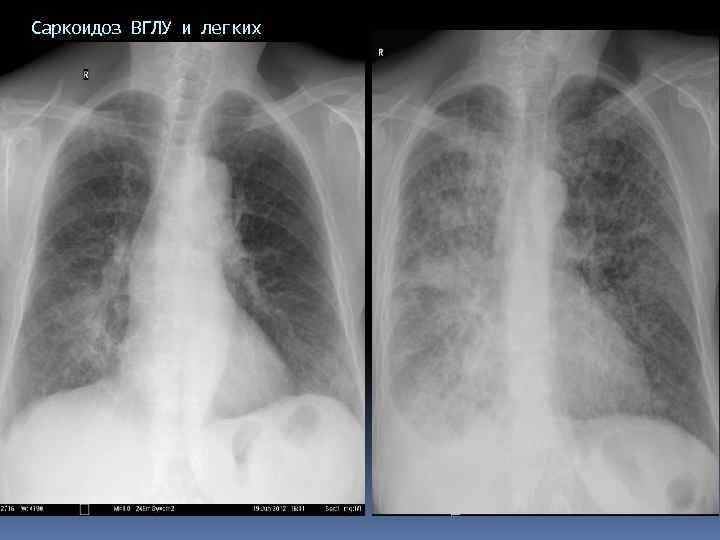 Саркоидоз легких на рентгене фото