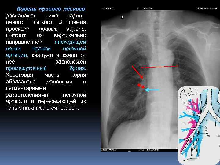 Корень правого и левого легкого. Корень легкого на рентгенограмме схема. Корень легкого строение рентген. Структура корня легкого на рентгенограмме. Рентгеновских образования корня левого легкого.