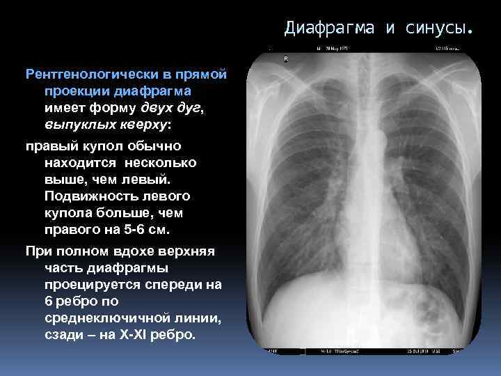 Диафрагма и синусы. Рентгенологически в прямой проекции диафрагма имеет форму двух дуг, выпуклых кверху: