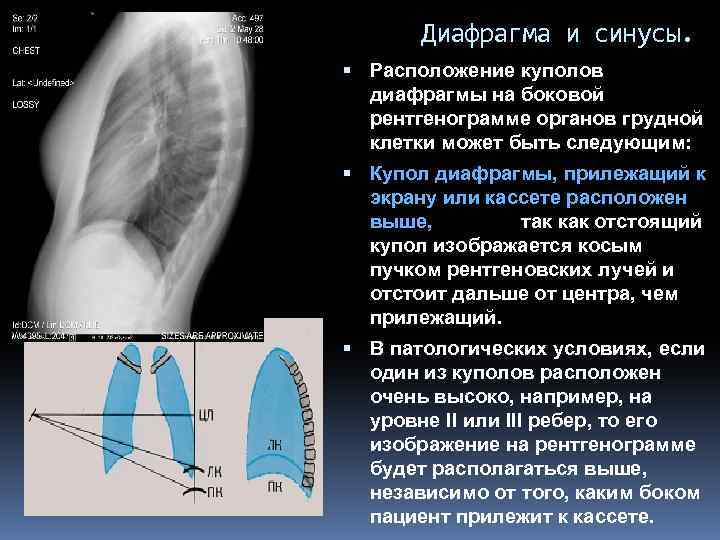 Проекции рентгена. Синусы на боковой рентгенограмме. Уплощение купола диафрагмы рентген. Купол диафрагмы на рентгенограмме. Плевральные синусы на рентгене.