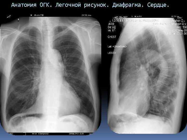 Анатомия ОГК. Легочной рисунок. Диафрагма. Сердце. 