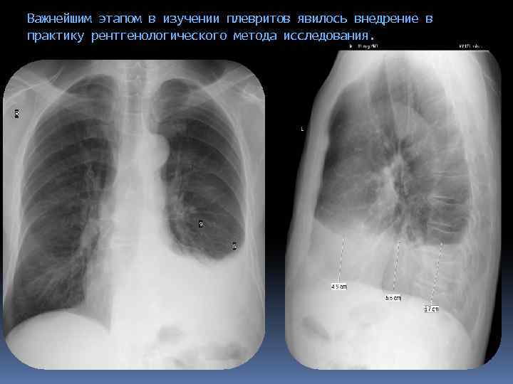 Важнейшим этапом в изучении плевритов явилось внедрение в практику рентгенологического метода исследования. 