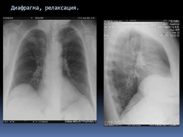 Релаксация диафрагмы. Двойной купол диафрагмы на рентгенограмме. Релаксация диафрагмы рентген. Частичная релаксация диафрагмы рентгенодиагностика. Рентген органов грудной клетки купол диафрагмы релаксирован.