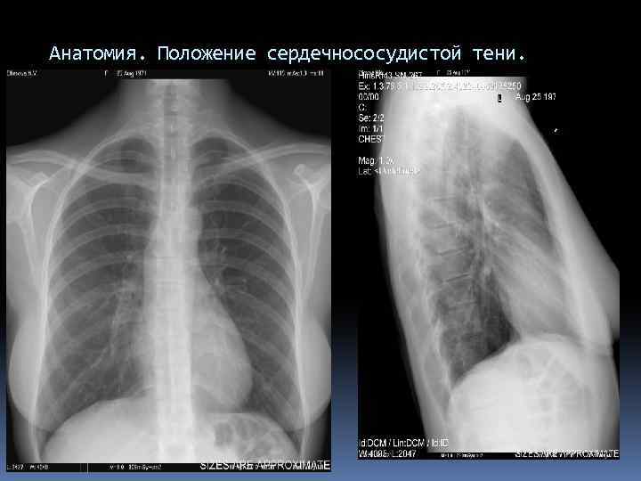 Анатомия. Положение сердечнососудистой тени. 