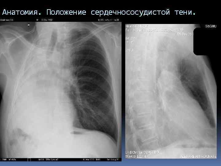 Анатомия. Положение сердечнососудистой тени. 