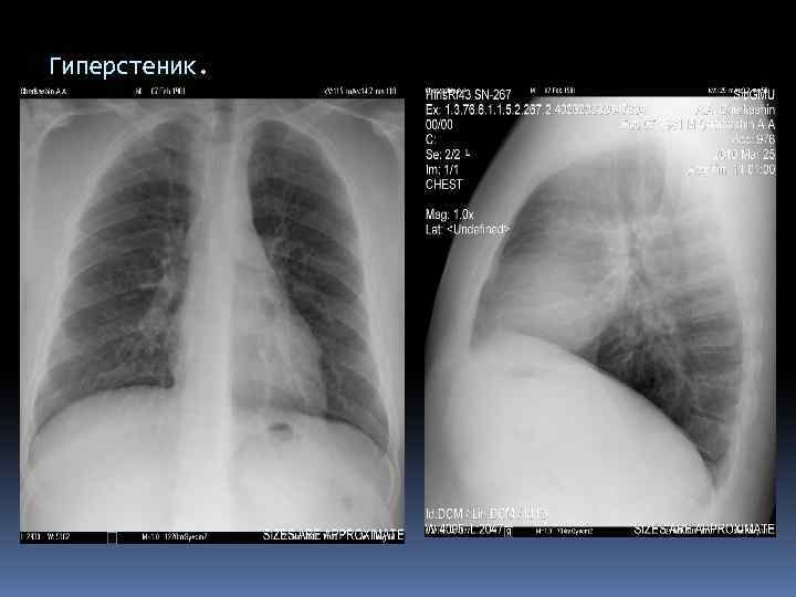 Гиперстеник. 