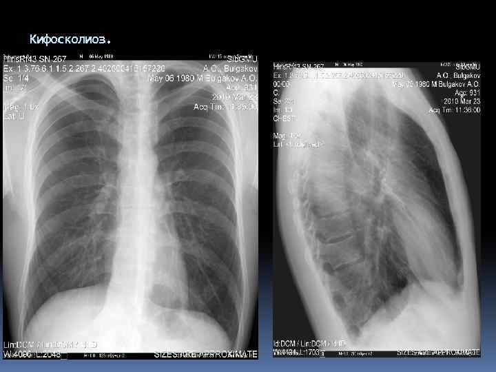 Кифосколиоз. 