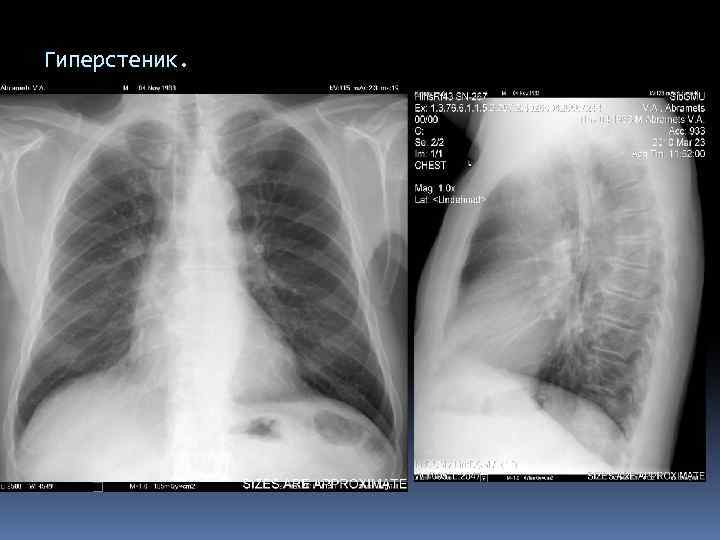 Гиперстеник. 