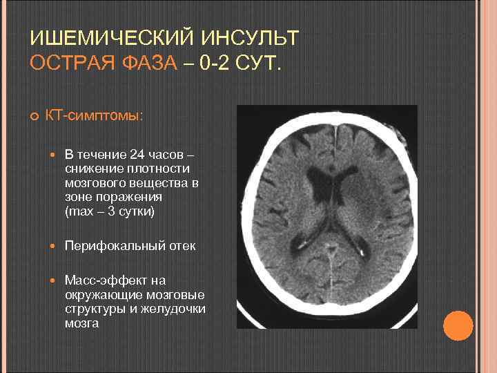 ИШЕМИЧЕСКИЙ ИНСУЛЬТ ОСТРАЯ ФАЗА – 0 -2 СУТ. КТ-симптомы: В течение 24 часов –