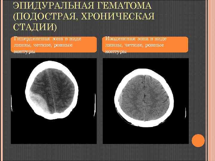 ЭПИДУРАЛЬНАЯ ГЕМАТОМА (ПОДОСТРАЯ, ХРОНИЧЕСКАЯ СТАДИИ) Гиперденсная зона в виде линзы, четкие, ровные контуры Изоденсная