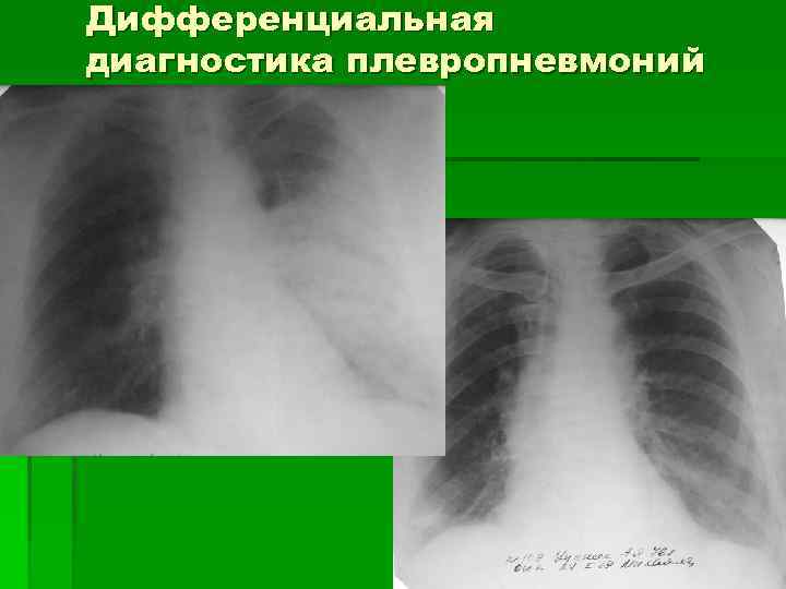 Дифференциальная диагностика плевропневмоний 