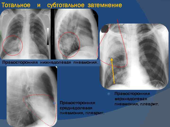 Правосторонняя пневмония. Правосторонняя среднедолевая пневмония рентген. Рентген правосторонней среднедолевой пневмонии. Правосторонняя нижнедолевая пневмония рентген. Среднедолевая пневмония на рентгенограмме.