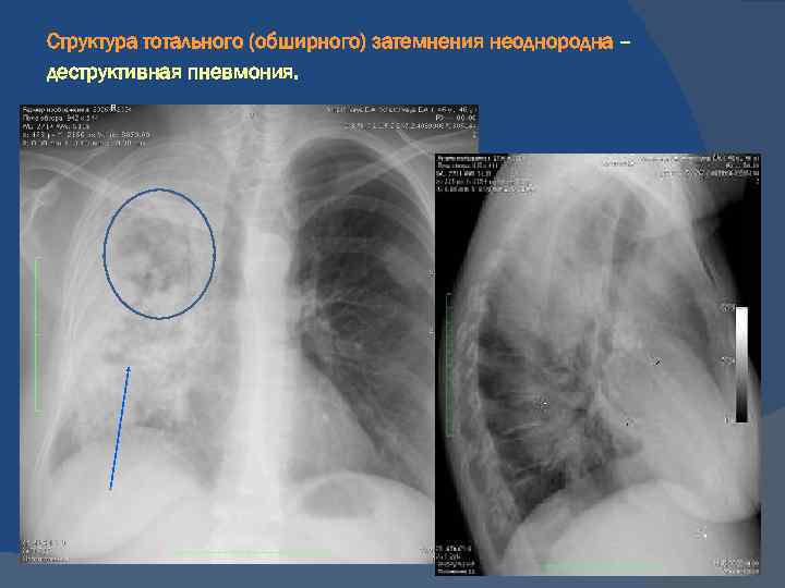 Негомогенное затемнение