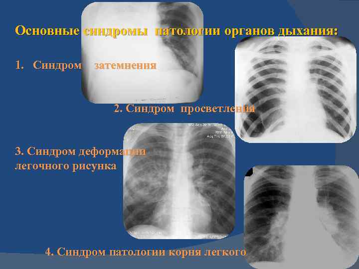 Мелкосетчатая деформация легочного рисунка