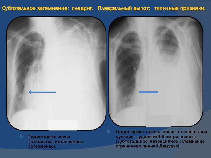 Почему на рентгеновском снимке изображение газа в плевральной полости черное