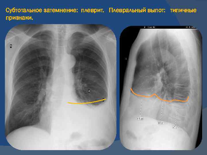 Плеврит легких фото