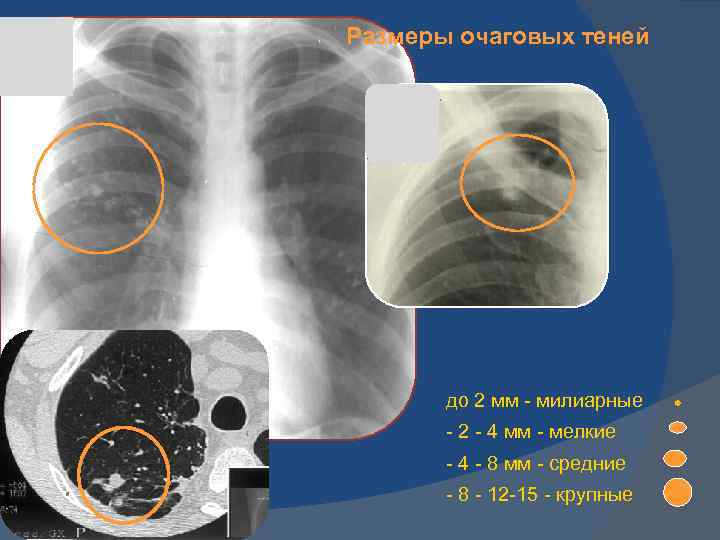 Легкие без очаговых теней