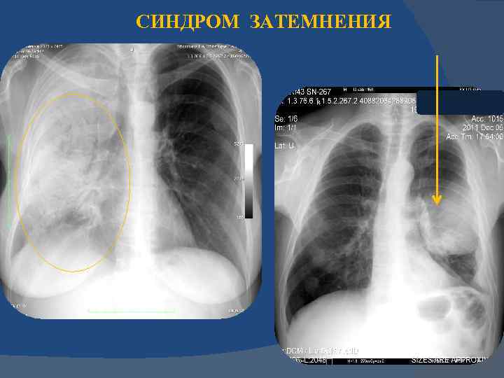 Обширное затемнение