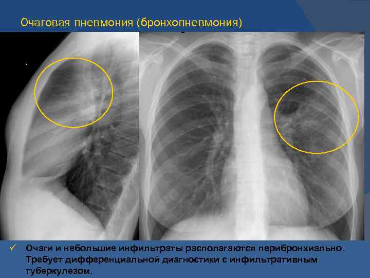 Поражения правого легкого. Очаговая пневмония бронхопневмония. Правосторонняя очаговая пневмония рентген. Двухсторонняя очаговая пневмония рентген. Очаговая пневмония легкого рентген.