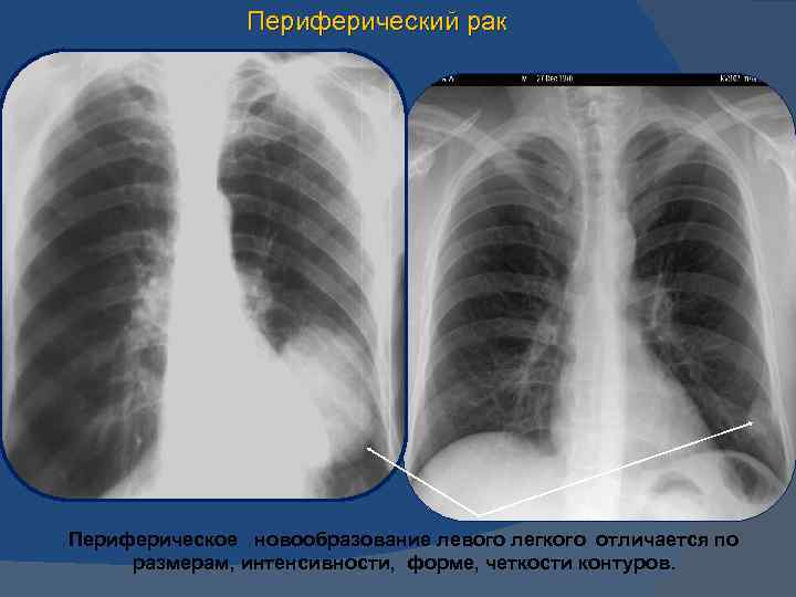 Периферический легких. Периферический очаг легкого. Периферические опухоли легких. Периферическая опухоль легкого. Опухоль левого легкого.